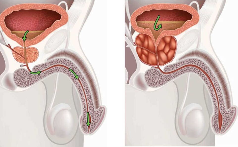 Entzündung vun der Prostata Drüs