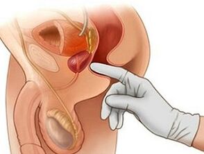 Prostata Massage fir d'Behandlung vu Prostatitis bei Männer