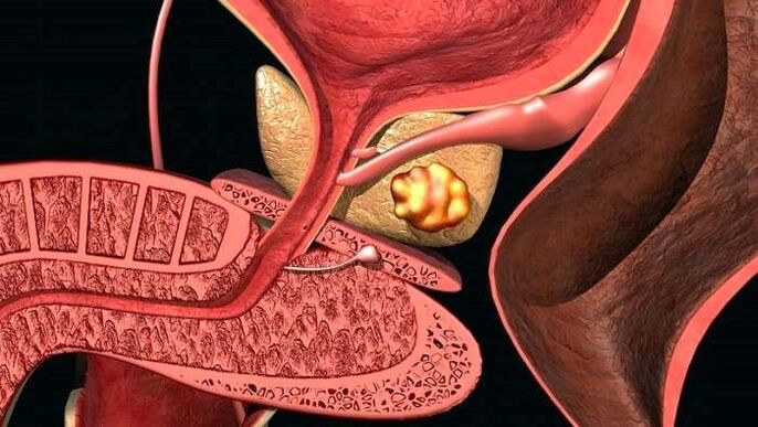Steenablagerungen an der Prostata mat calculous Prostatitis