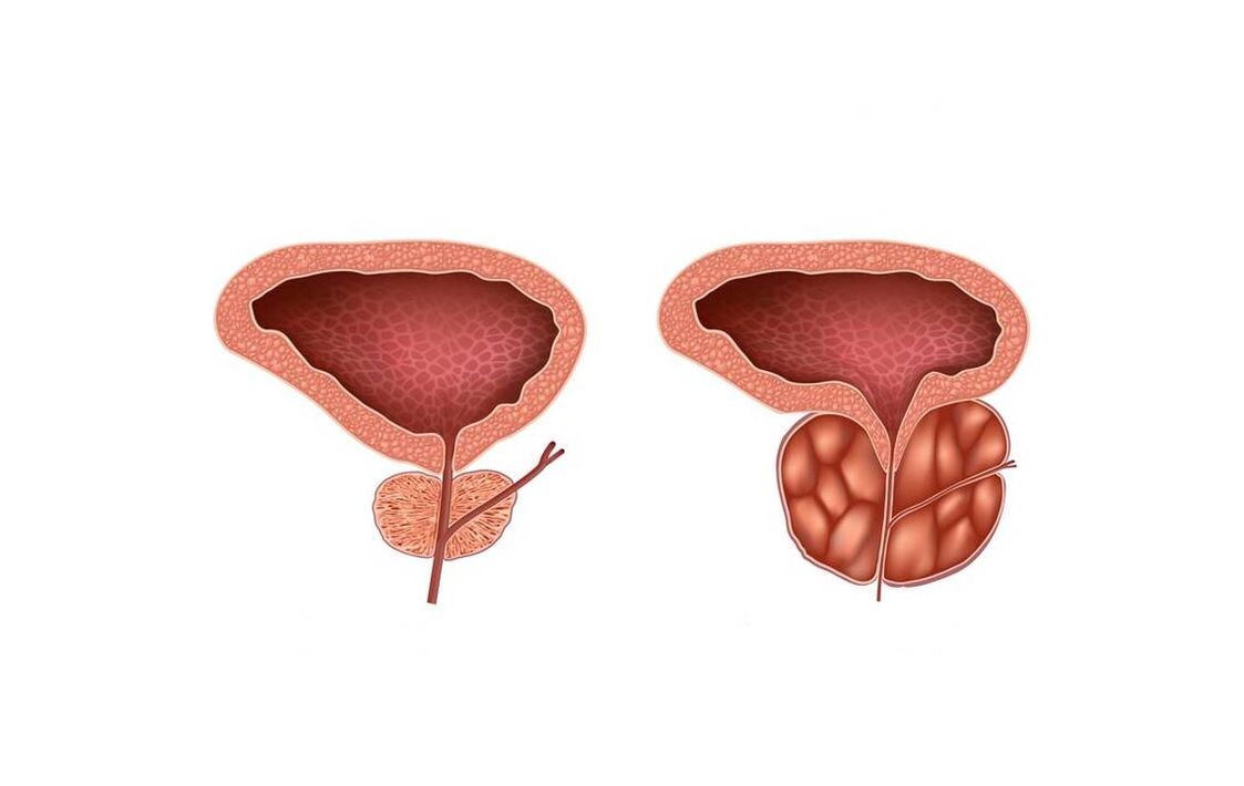 Symptomer vun Prostatitis bei Männer