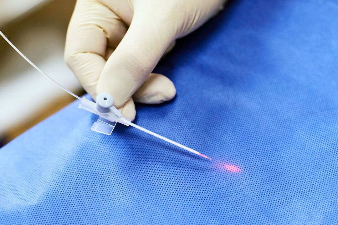 transrektal Apparat fir Prostatabehandlung