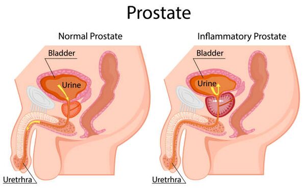 gesond an entzündete Prostata