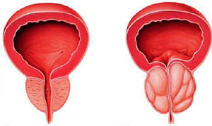 Normal Prostata (lénks) an entzündegt chronesch Prostatitis (riets)