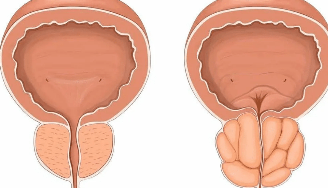 gesond a krank Prostata
