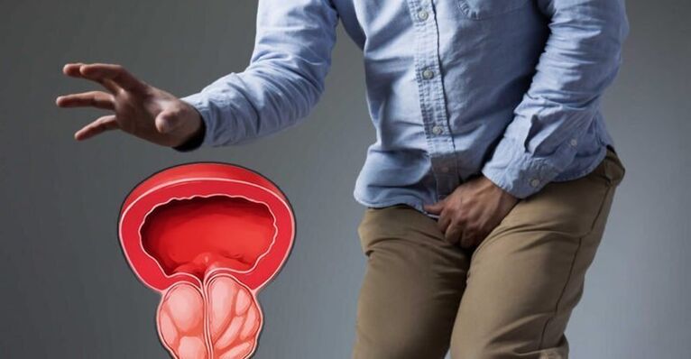 Symptomer vun Prostatitis bei Männer