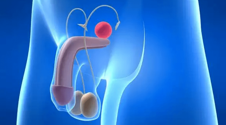 Prostatitis ass eng Entzündung vun der Prostata Drüs bei Männer, déi komplex Behandlung erfuerdert